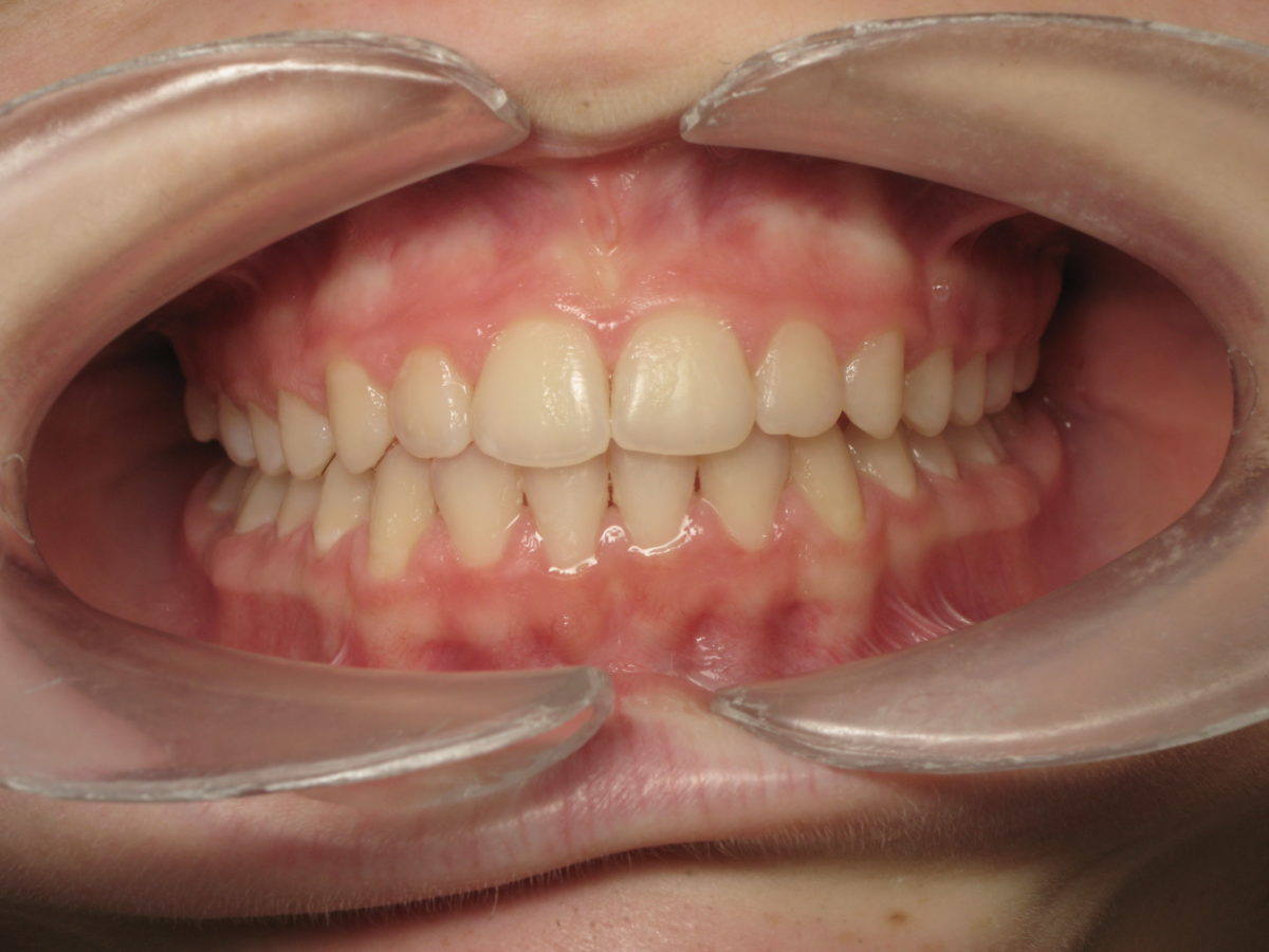 Traitement orthodontique adolescent