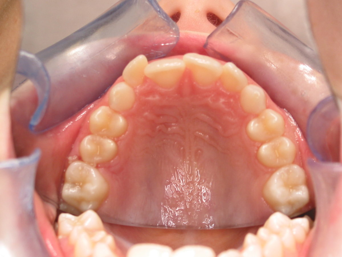 Traitement orthodontique adolescent