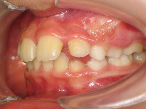 Traitement orthodontique enfant