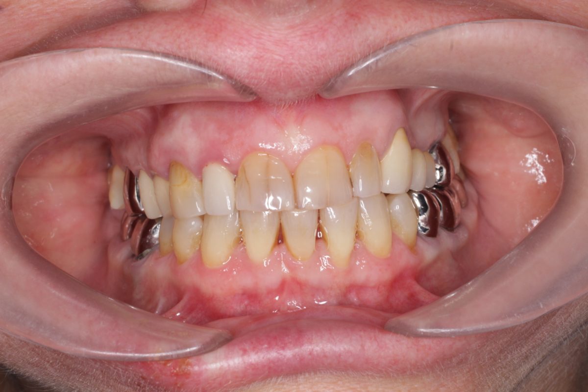 Traitement orthodontique senior